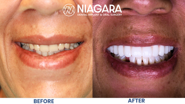 Comparison of teeth before and after dental treatment, showing improved teeth alignment and whitening, with the before image showing misaligned and discolored teeth and the after image showing straight, white teeth. The image is branded with the Niag