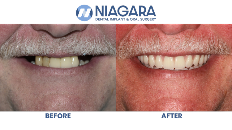 Comparison of a person's teeth before and after dental treatment, showing improved and whiter teeth on the right.