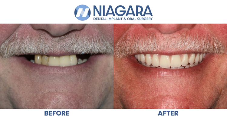 Gale, Michael - Before & After (White BR).png