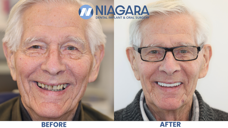 Comparison of an elderly man’s face before and after dental work, showing improved teeth and smile. The before side has missing and discolored teeth, while the after side has a full set of white teeth. The man is smiling in both images, wearing glasses in the after photo.